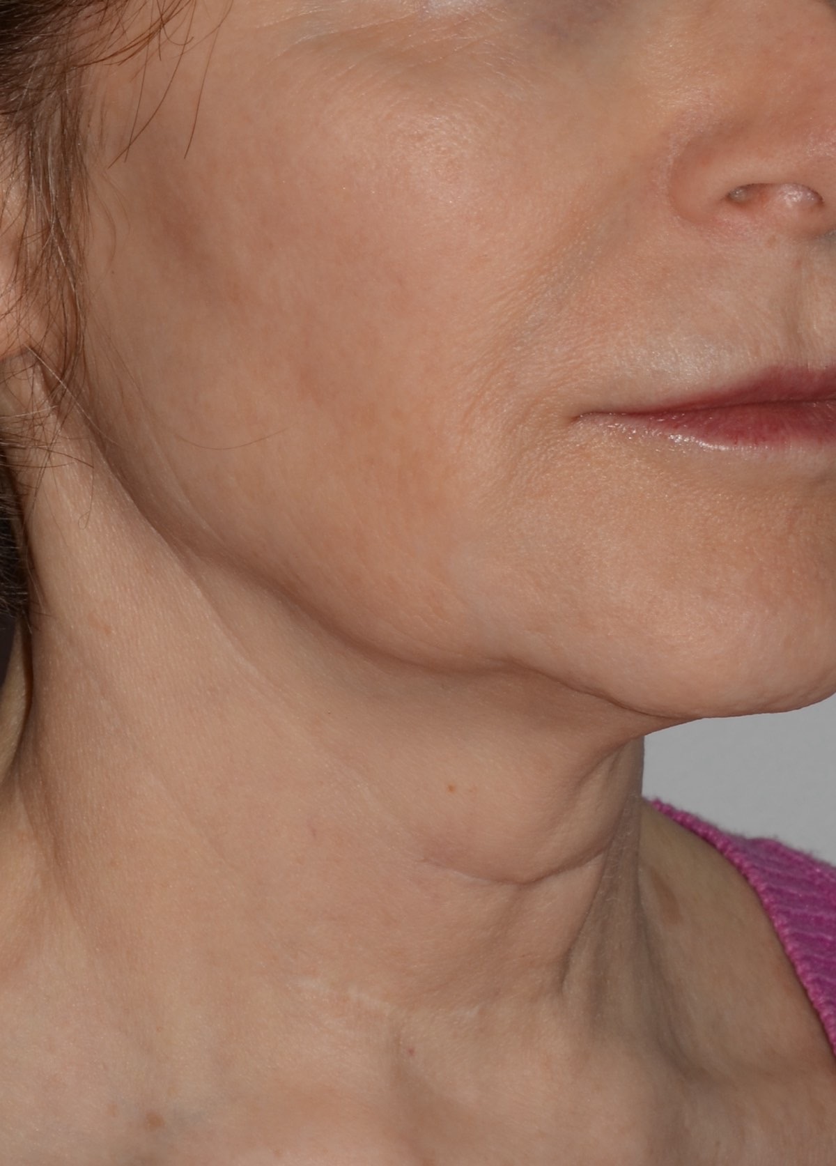 Face & Neck Lift