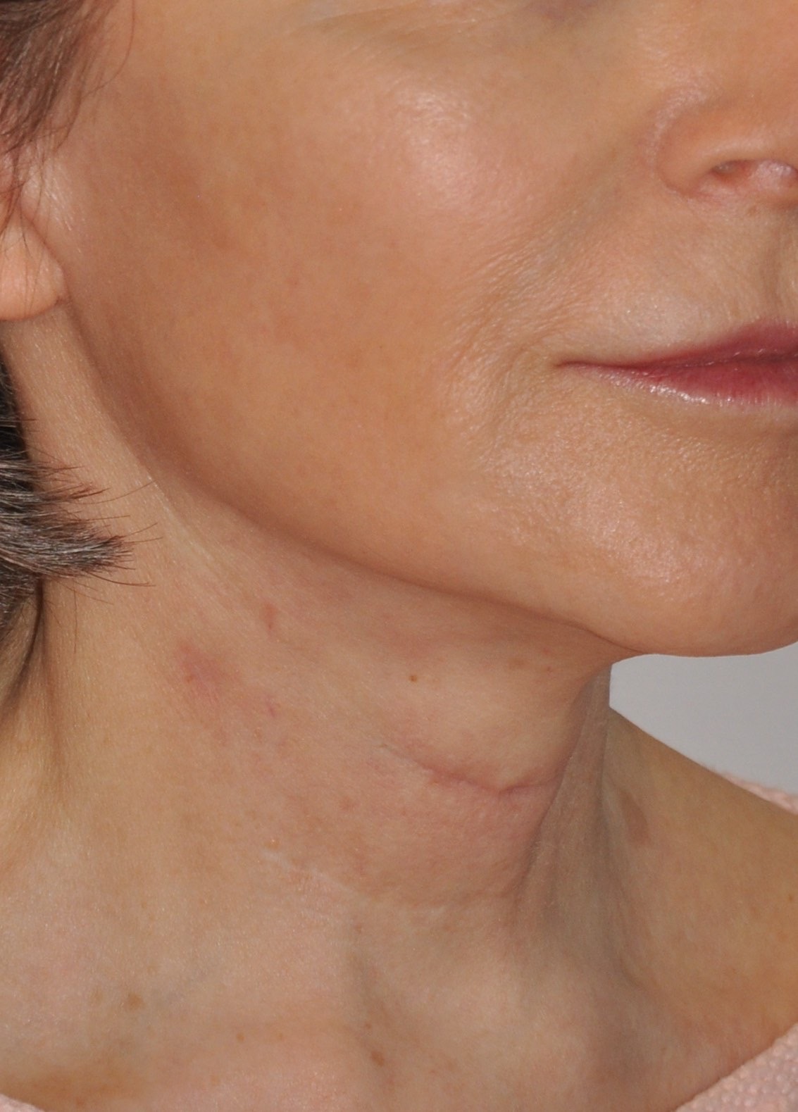 Face & Neck Lift