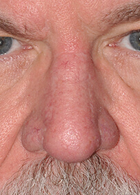 Nose Reconstruction