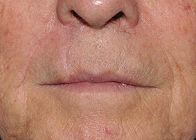 Lip Reconstruction