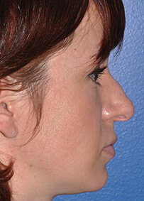 Rhinoplasty