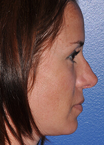 Rhinoplasty