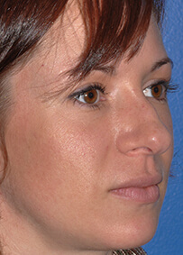 Rhinoplasty