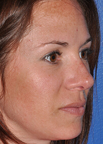 Rhinoplasty