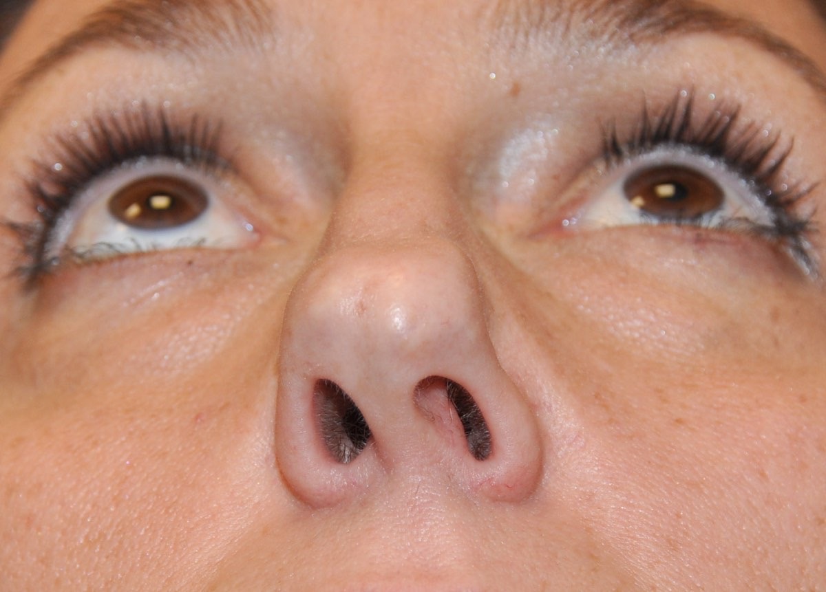 Nasal Surgery for Breathing