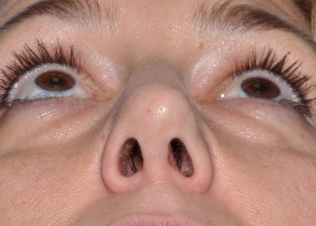 Nasal Surgery for Breathing