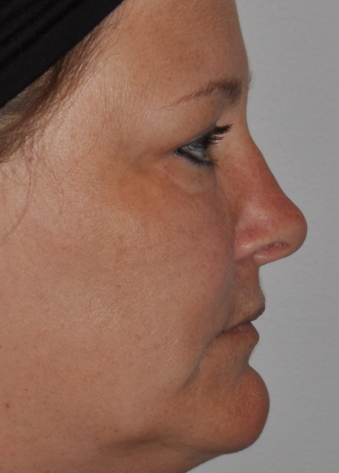 Revision Rhinoplasty