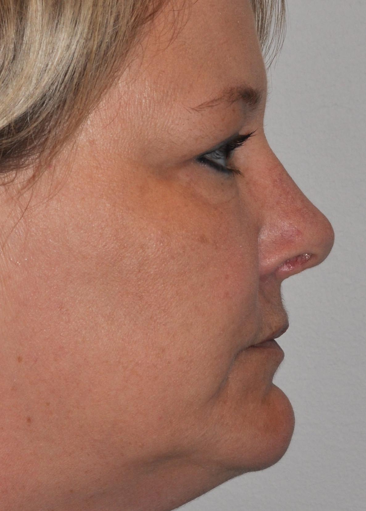 Revision Rhinoplasty