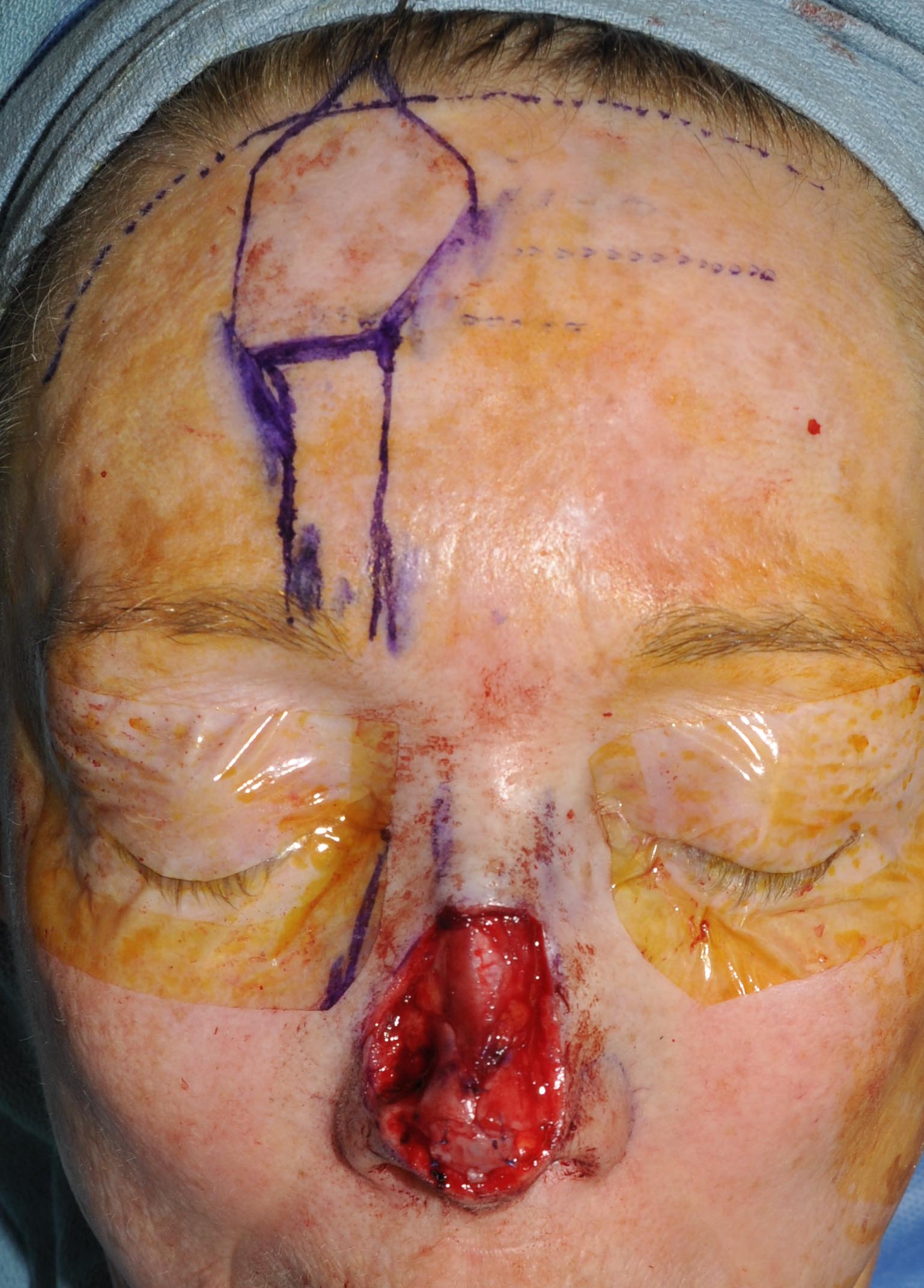 Nose Reconstruction