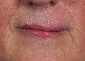 Lip Reconstruction