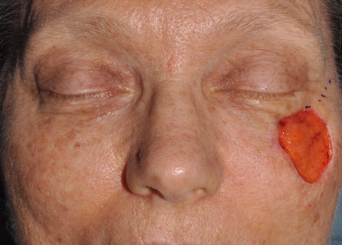 Eyelid & Cheek Reconstruction