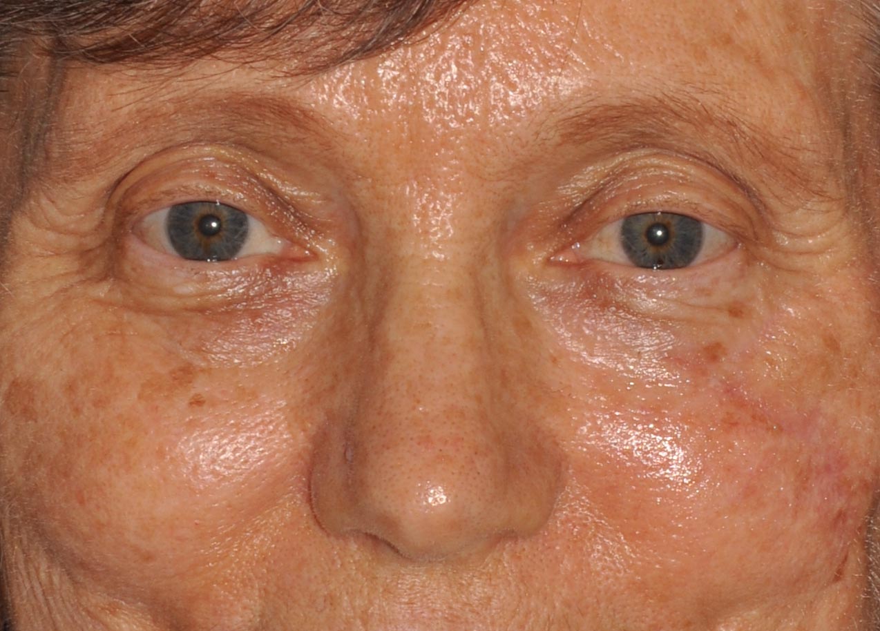 Eyelid & Cheek Reconstruction