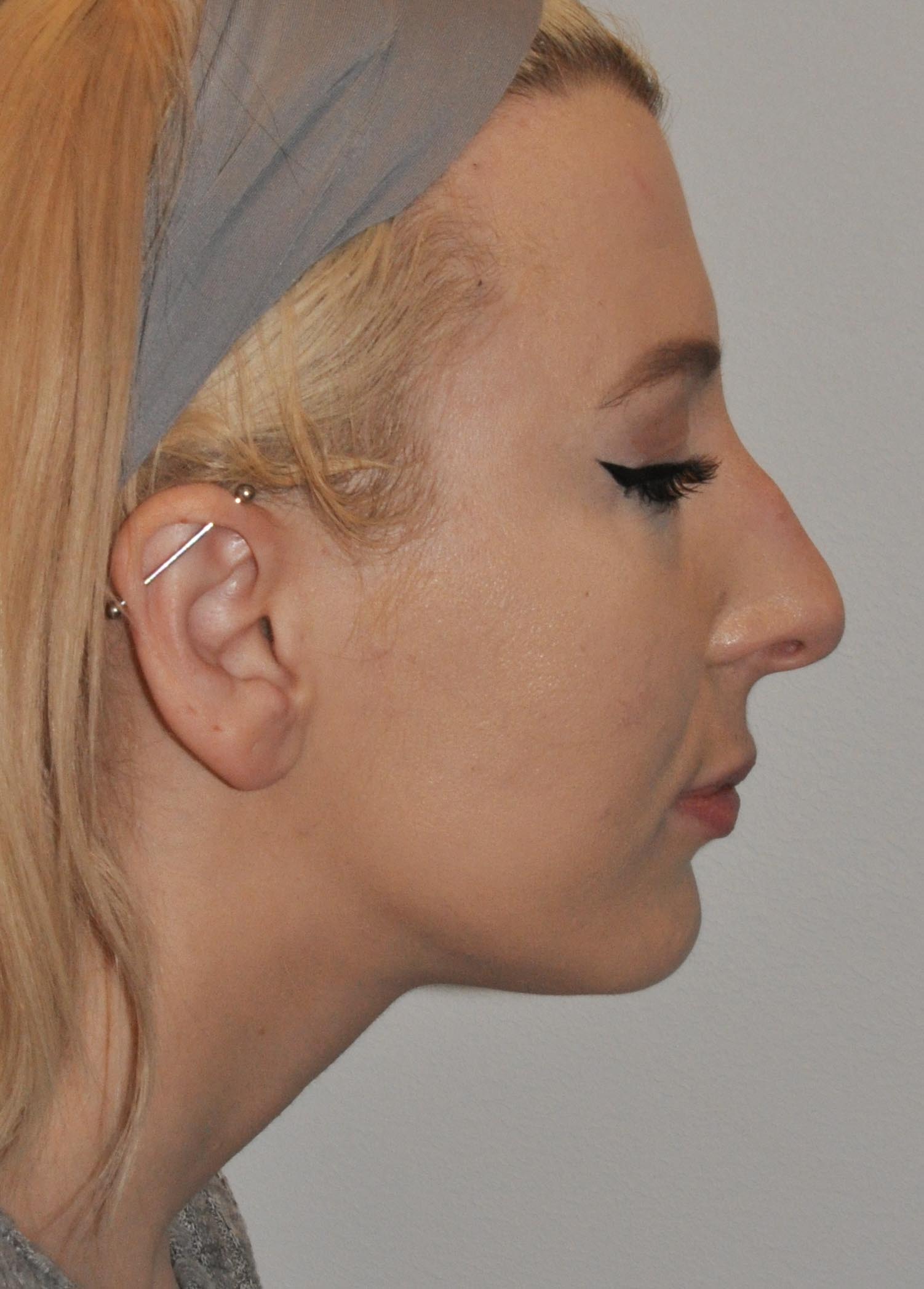 Rhinoplasty