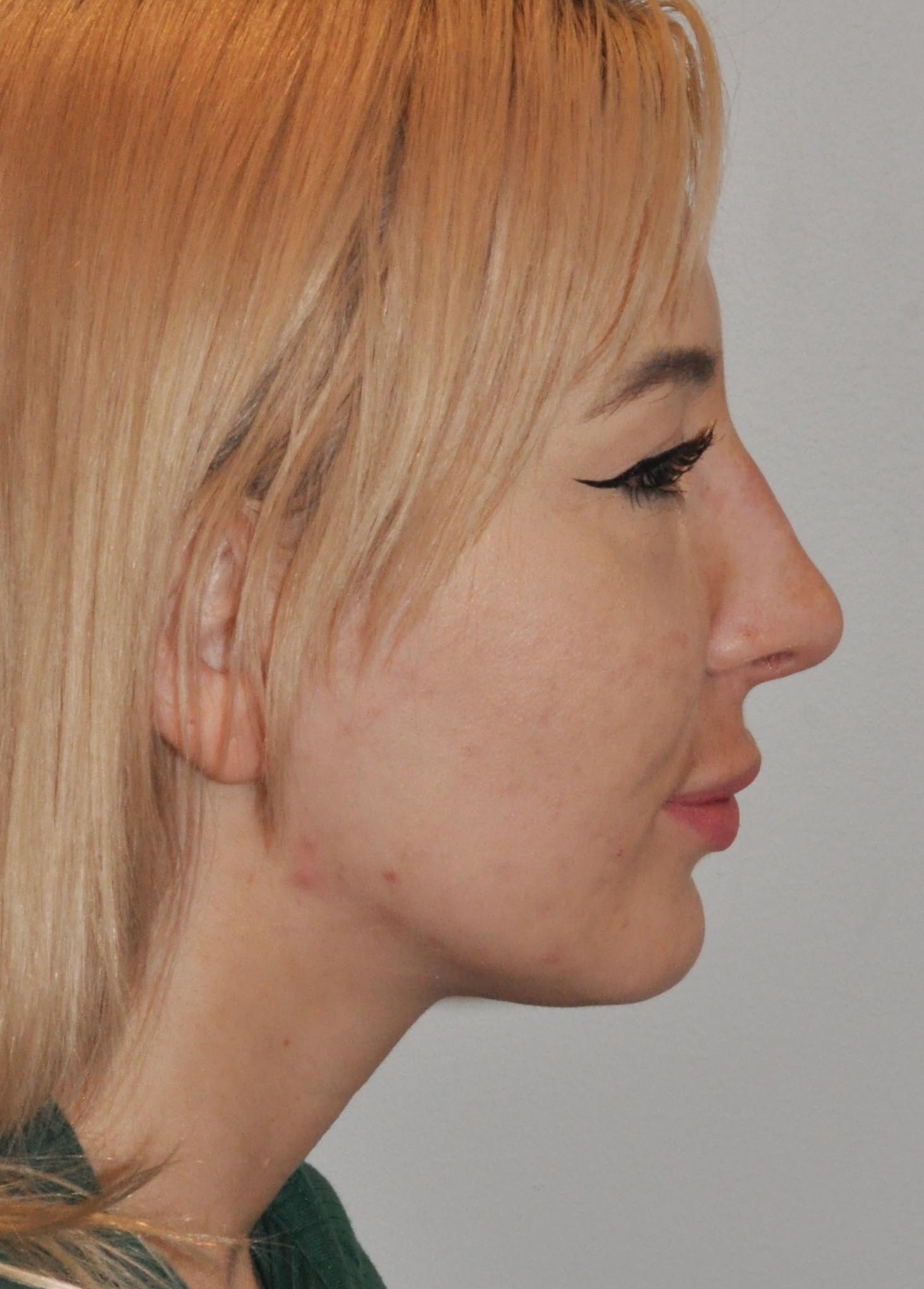 Rhinoplasty