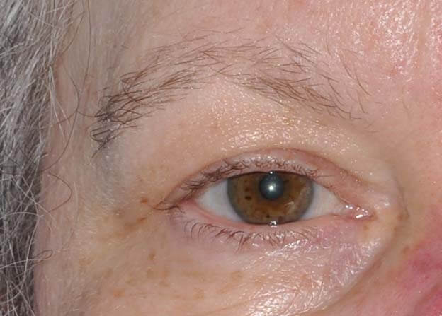 Blepharoplasty (Eyelid Lift)