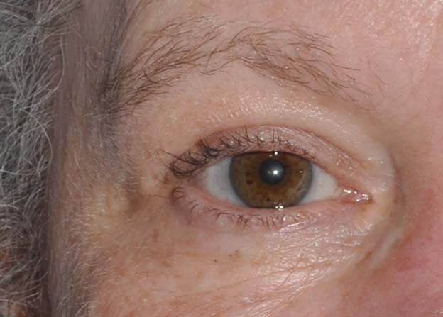 Blepharoplasty (Eyelid Lift)