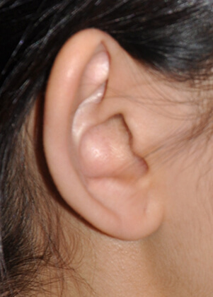 Otoplasty (Ear Reshaping)