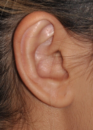 Otoplasty (Ear Reshaping)