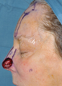 Nose Reconstruction