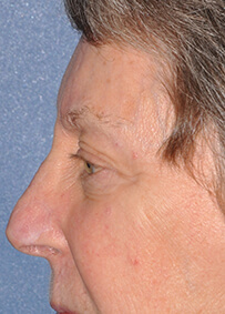 Nose Reconstruction