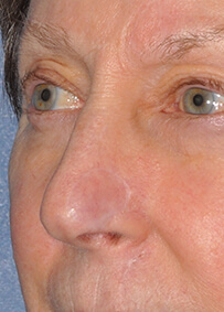 Nose Reconstruction