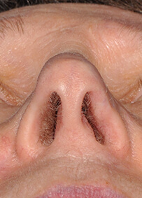 Nose Reconstruction