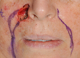 Eyelid & Cheek Reconstruction