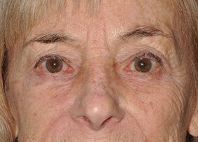 Eyelid & Cheek Reconstruction