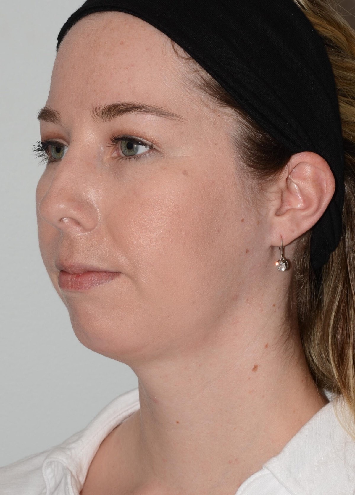 Chin Augmentation