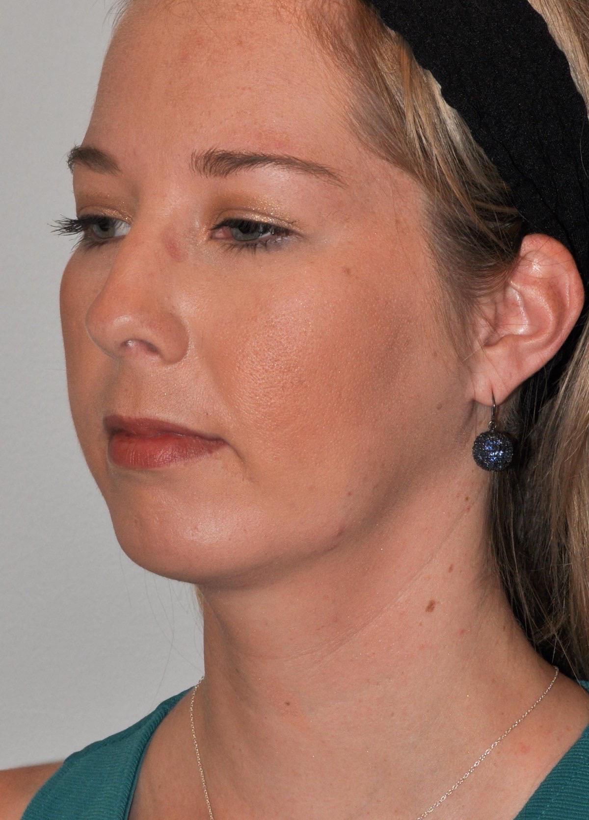 Chin Augmentation