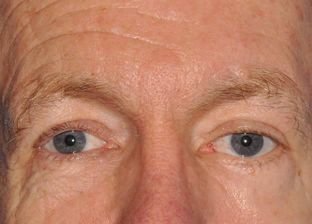 Brow Lift