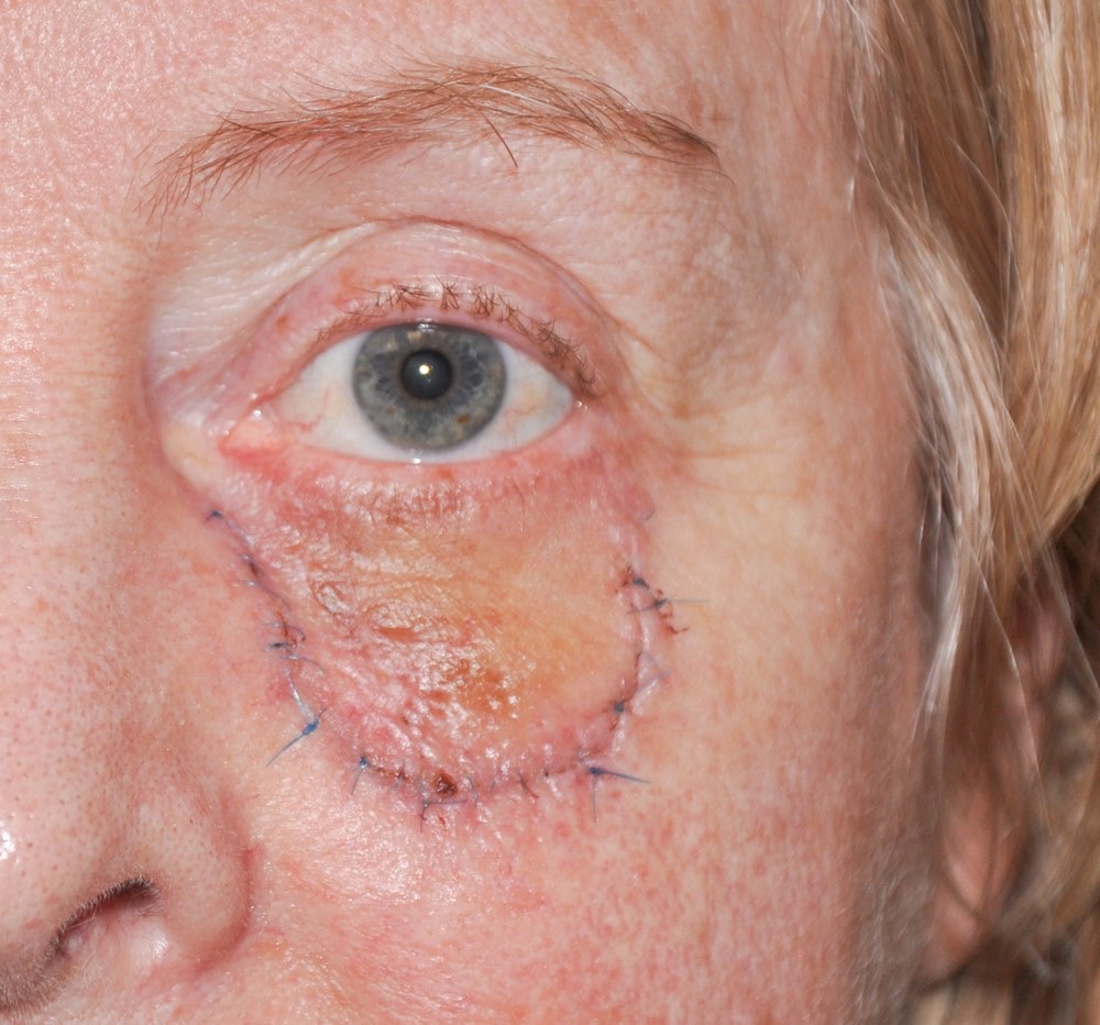 Eyelid & Cheek Reconstruction