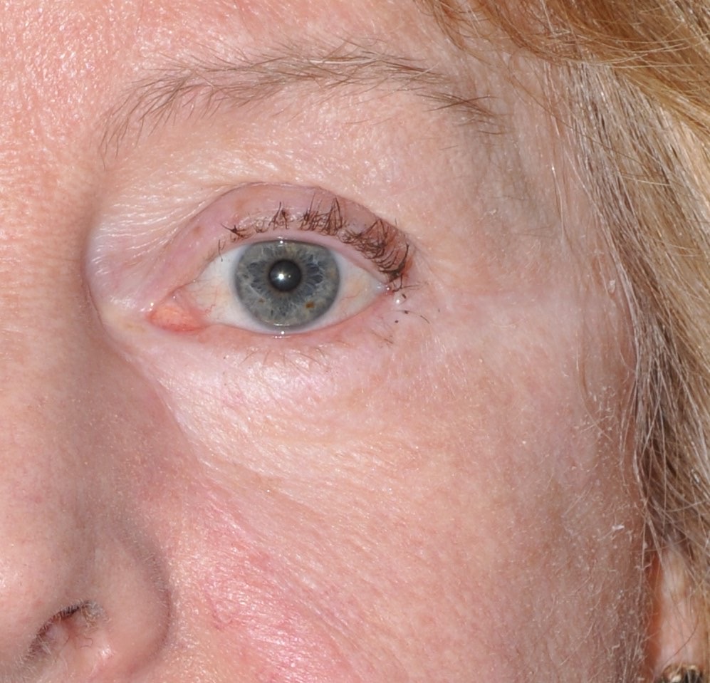 Eyelid & Cheek Reconstruction