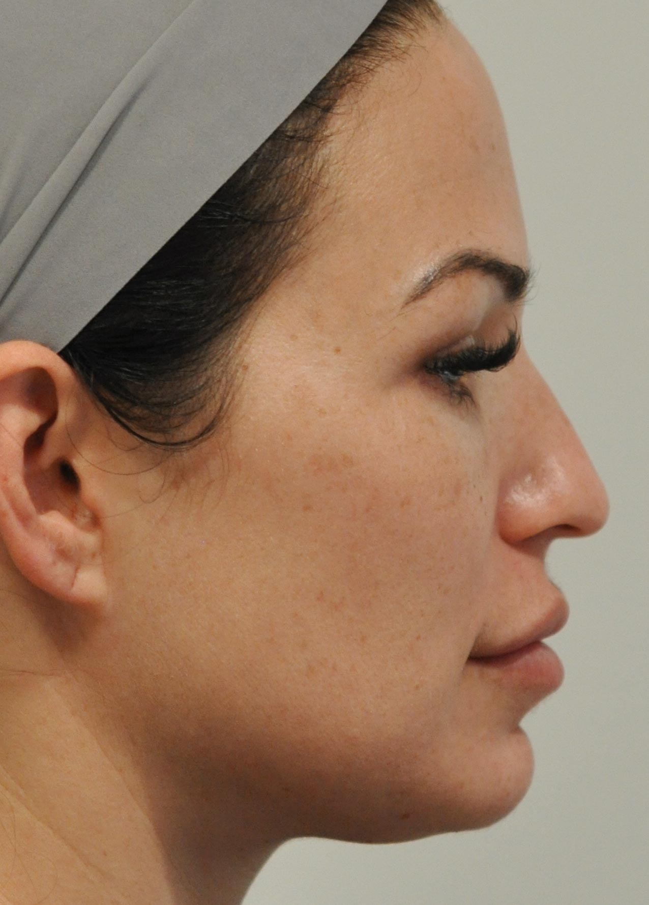 Rhinoplasty