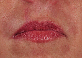 Lip Reconstruction