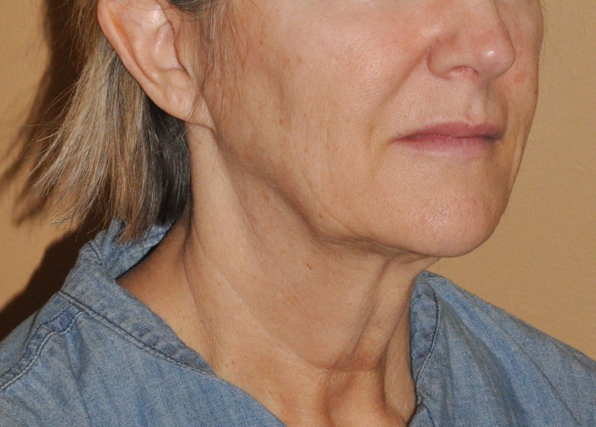 Face & Neck Lift