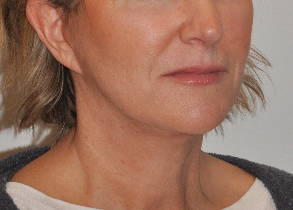 Face & Neck Lift