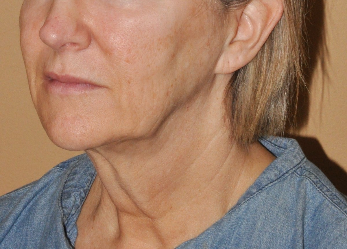 Face & Neck Lift