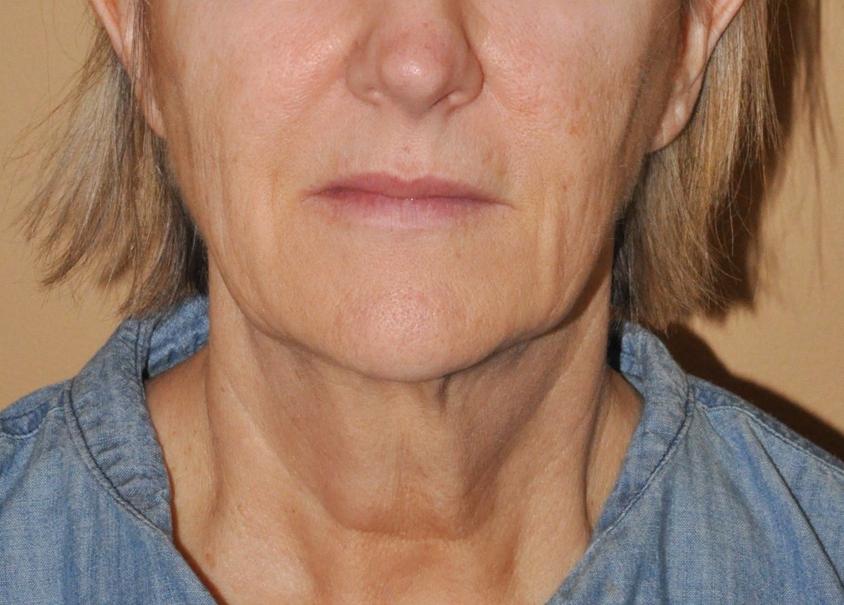 Face & Neck Lift