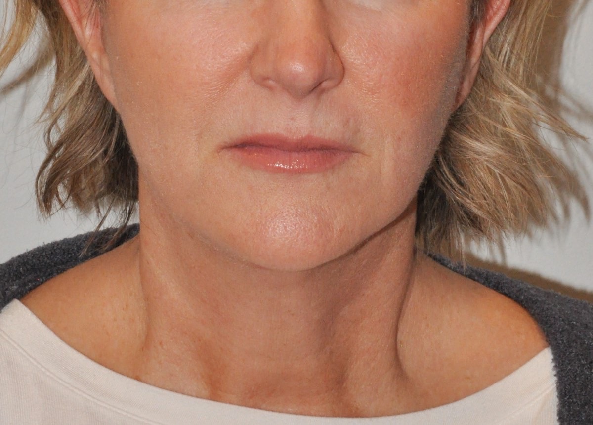 Face & Neck Lift