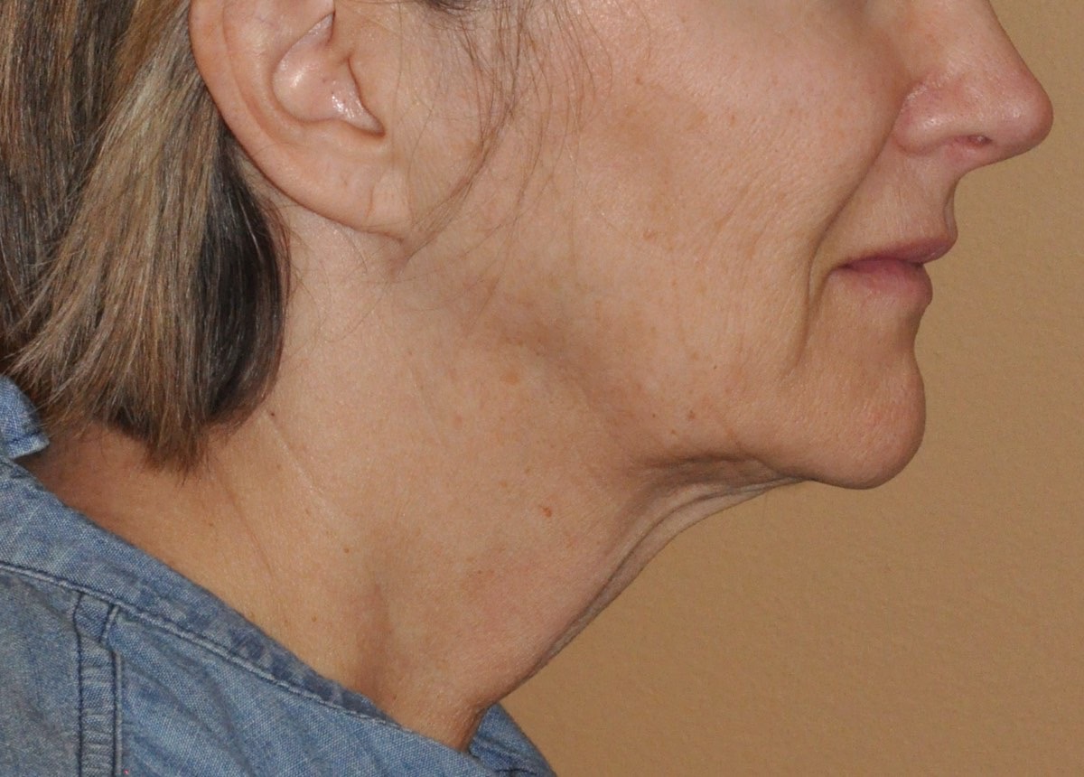 Face & Neck Lift