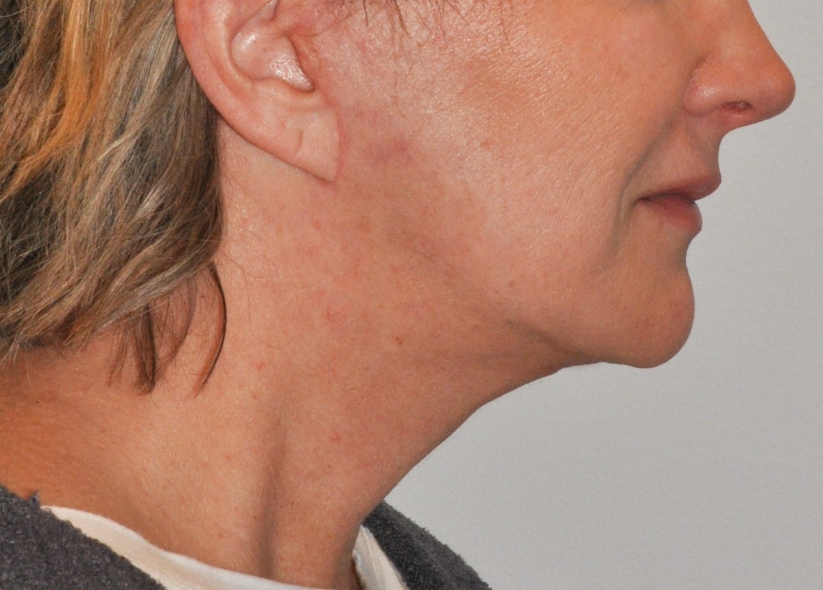 Face & Neck Lift