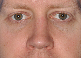 Rhinoplasty