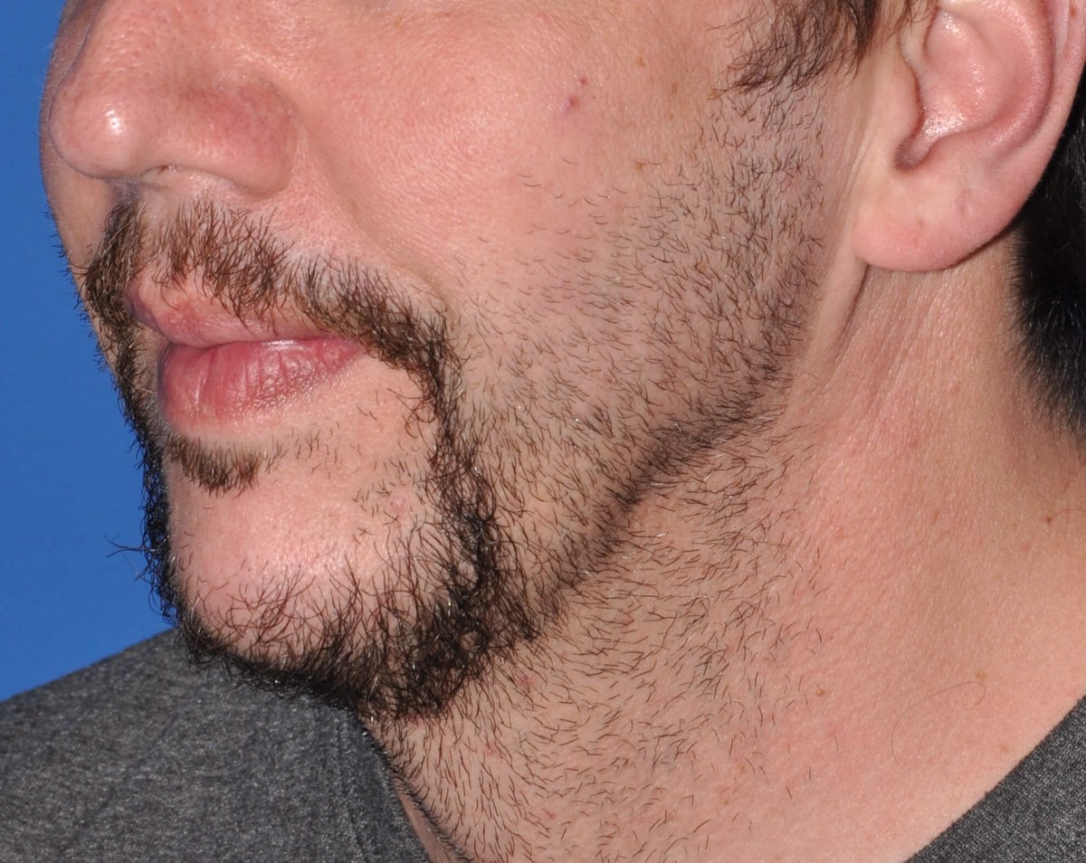 Chin Augmentation