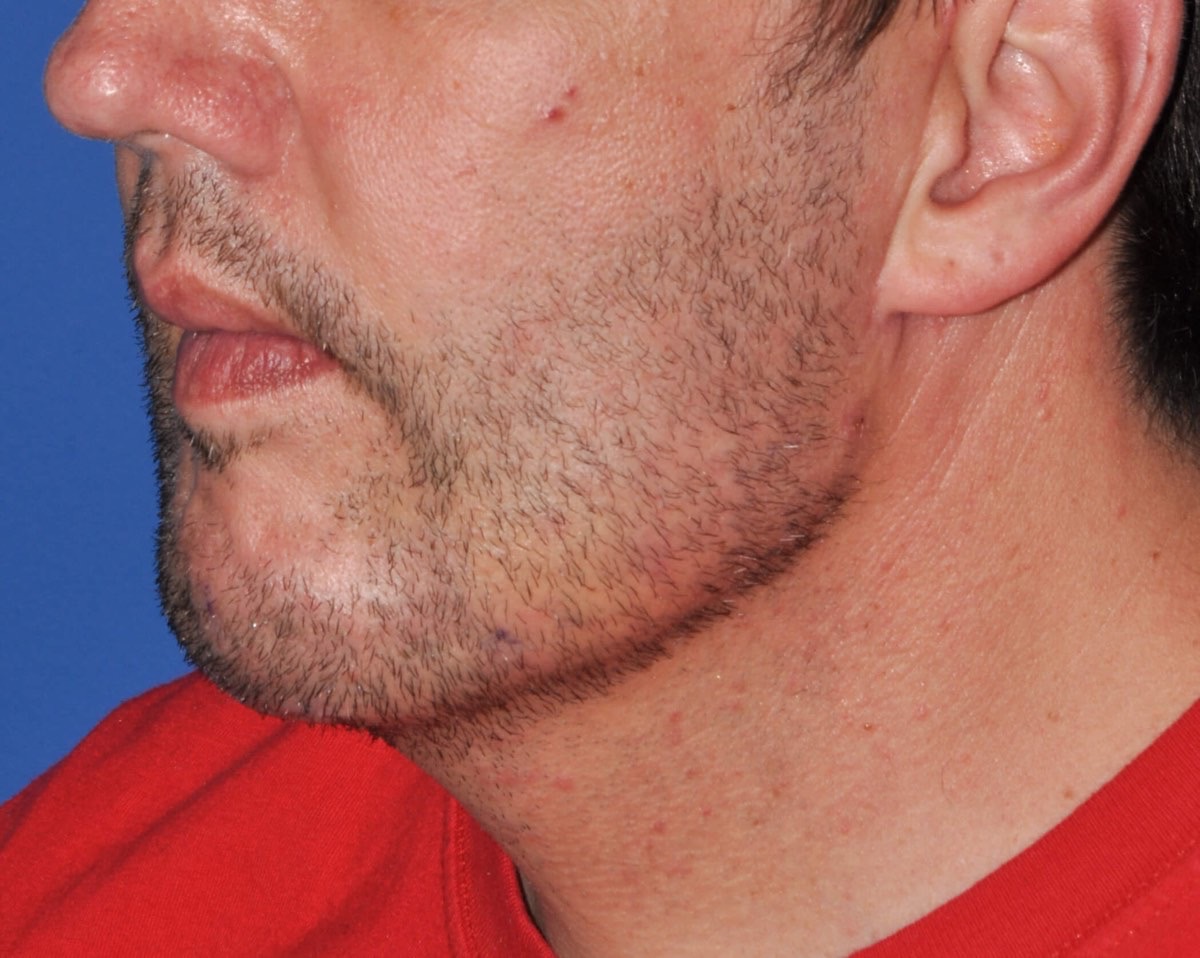 Chin Augmentation