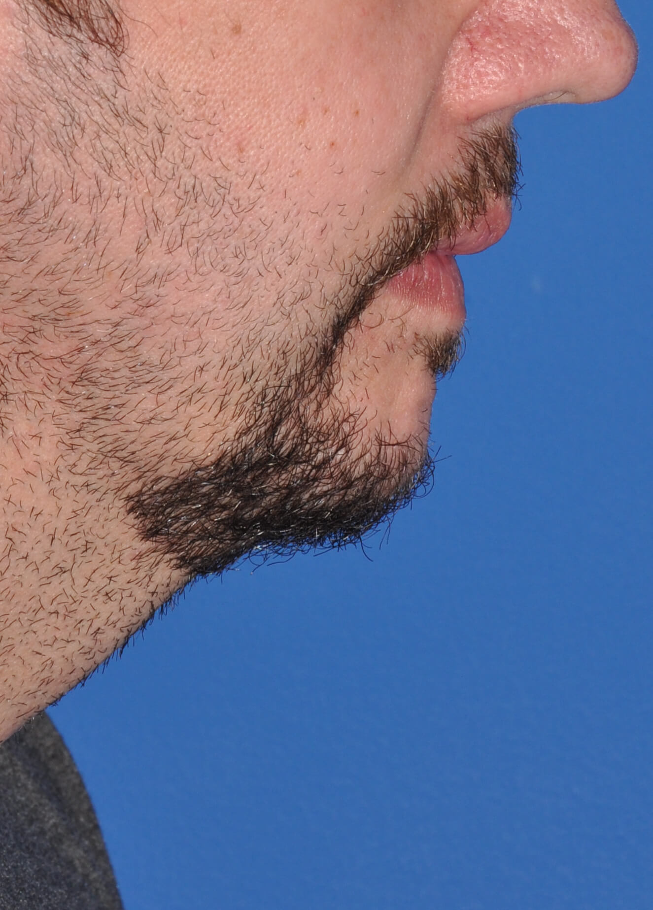 Chin Augmentation