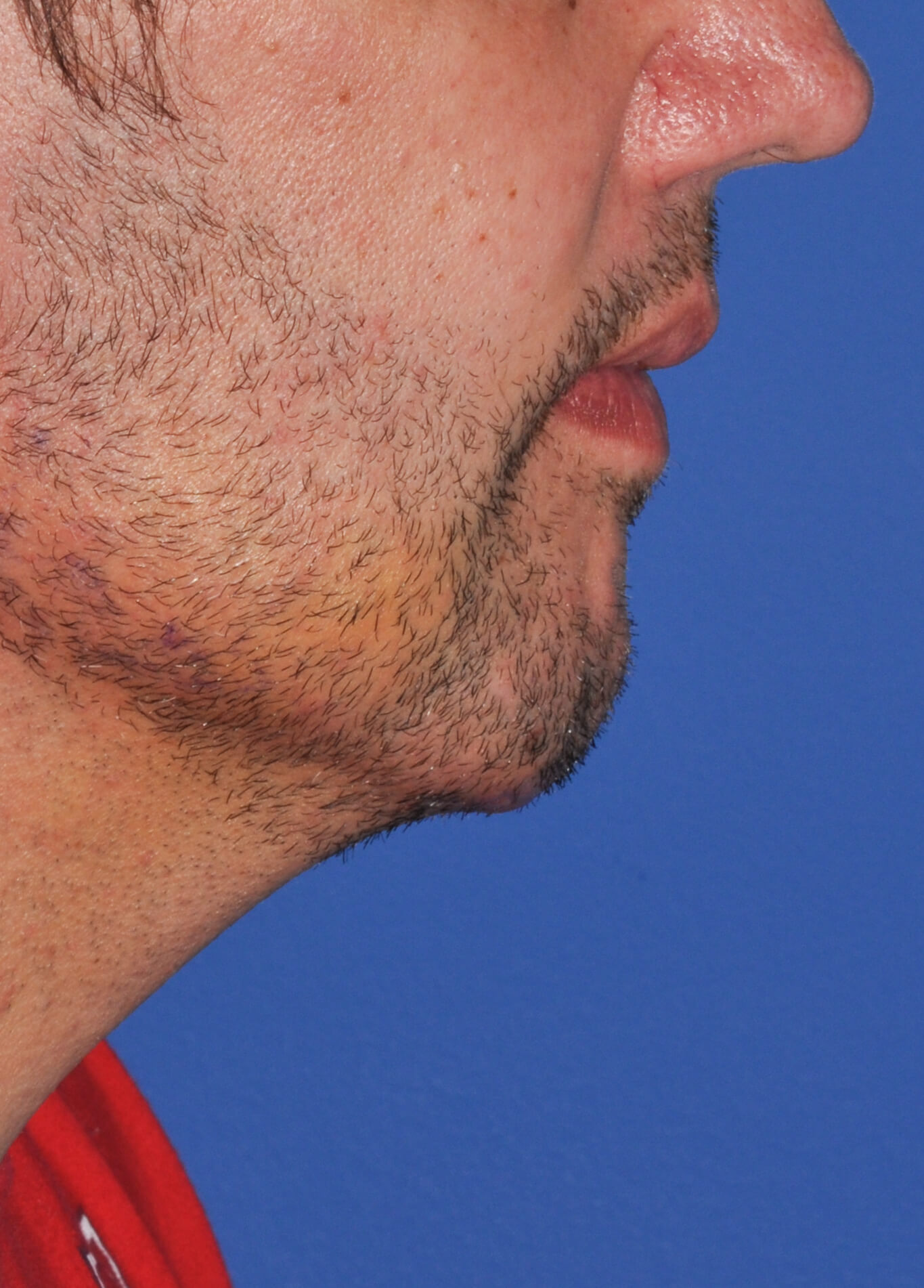 Chin Augmentation