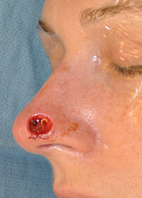 Nose Reconstruction