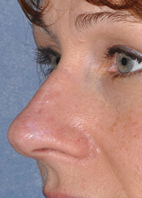 Nose Reconstruction