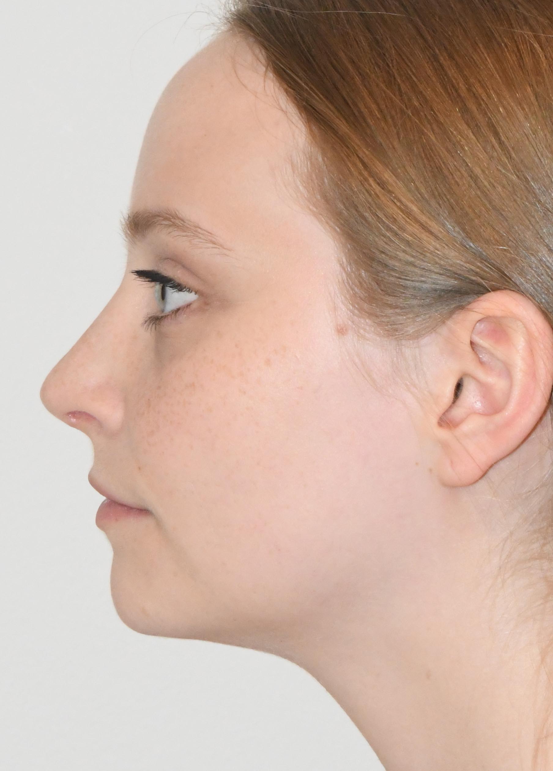 Rhinoplasty